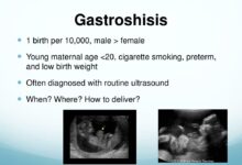 Gastroschisis