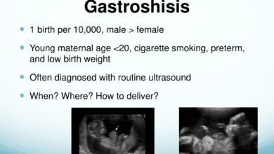 Gastroschisis