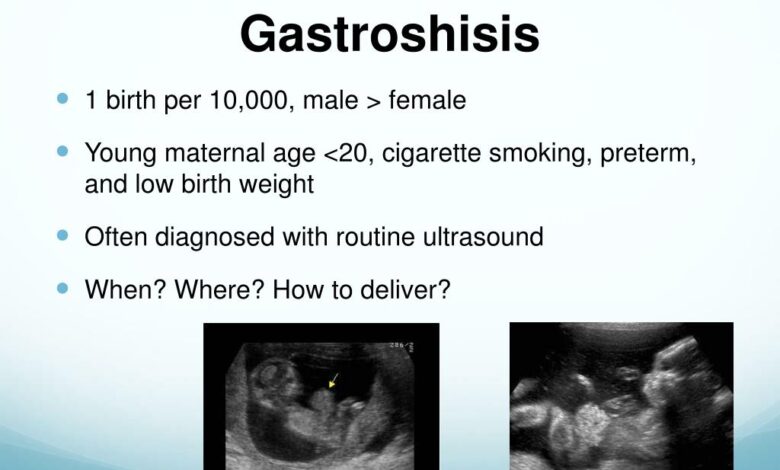 Gastroschisis